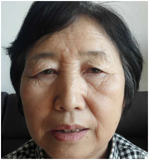 老年性眼睑皮肤松弛矫正手术前后对比照片