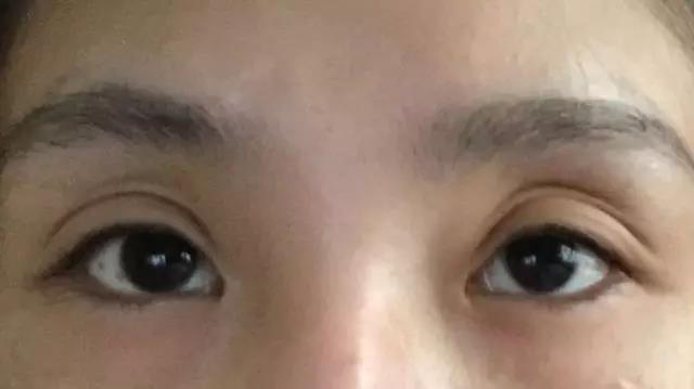 双眼皮失败为什么不能立即修复?