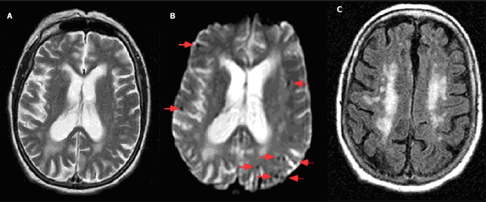 魏社鹏版医学百科 脑淀粉样血管病