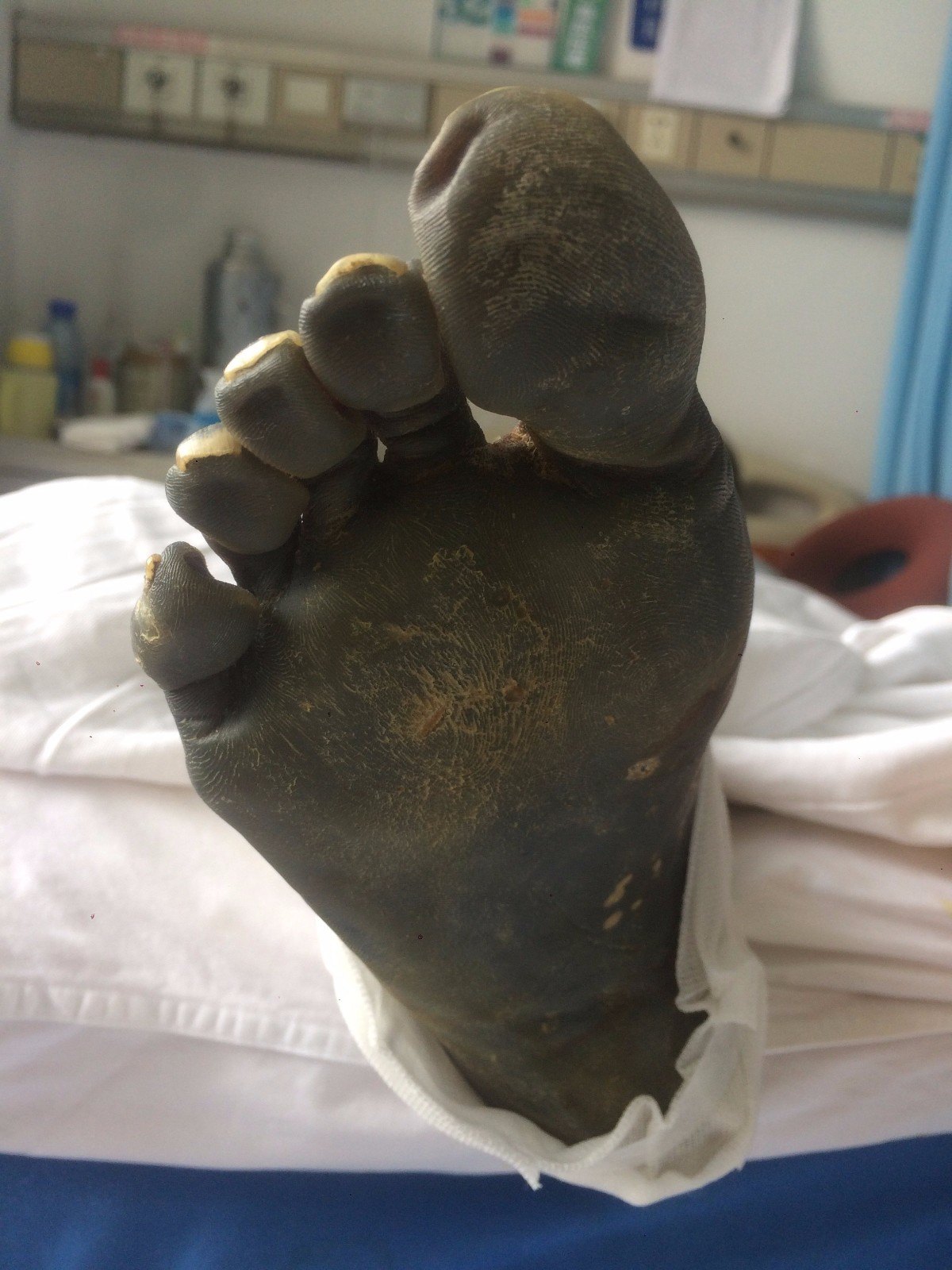 吃什么预防糖尿病足 vYYBAFsGWZyACFIzAAQcHdDUUpY442.jpg?_ms_=eb47