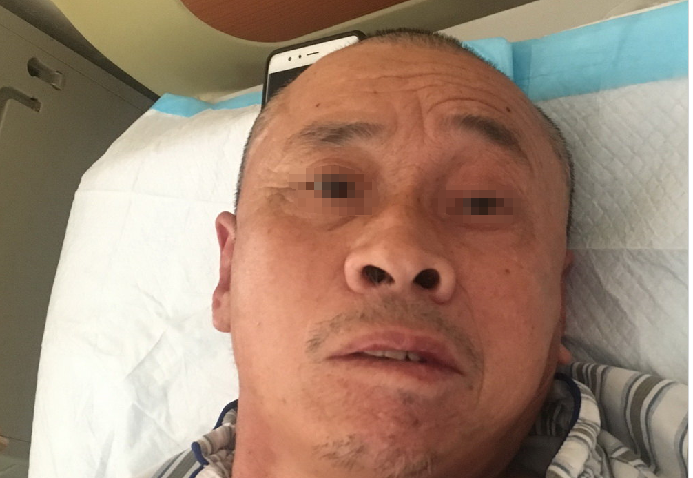 面瘫,嘱回当地医院继续面神经康复治疗术后病理诊断为听神经瘤术后八