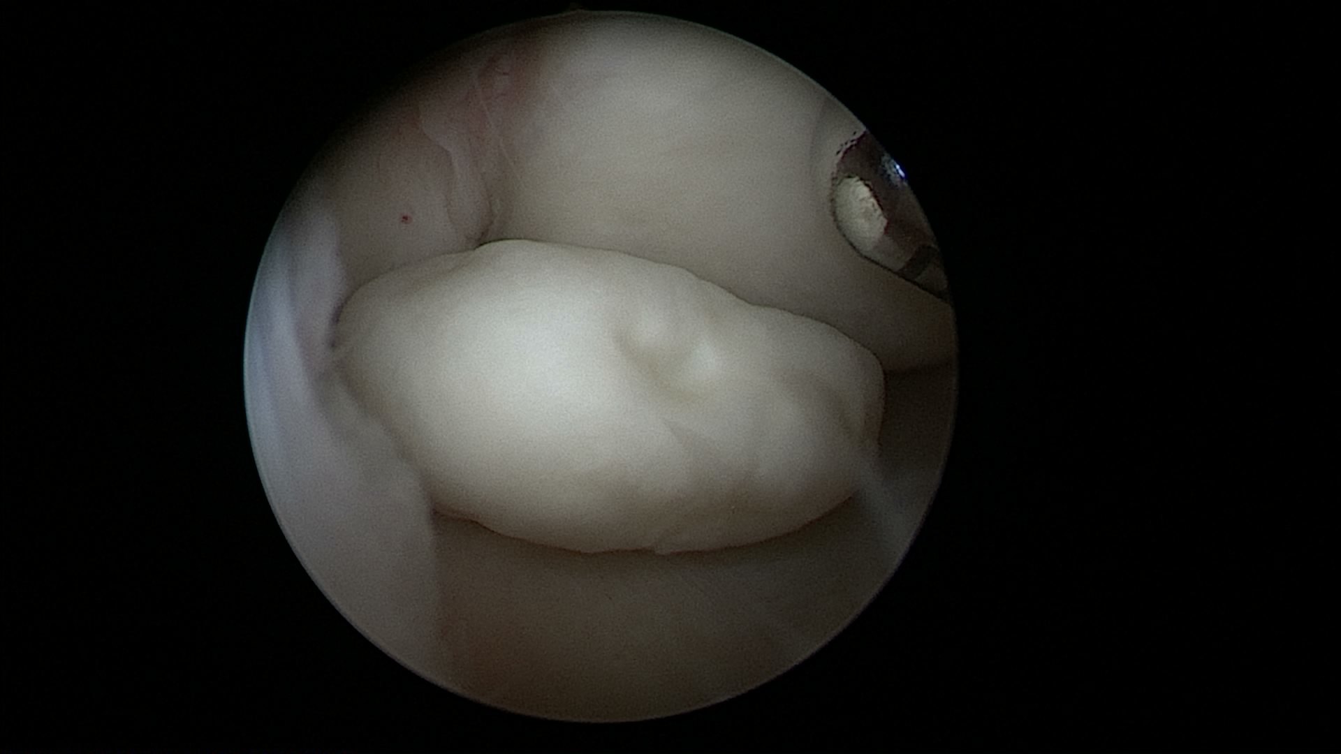 关节内游离体 - 好大夫在线