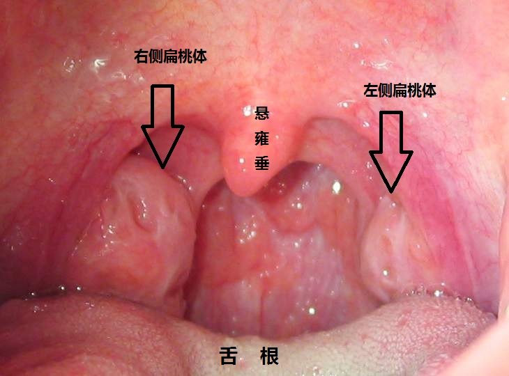扁桃体何时该手术切除 扁桃体炎 疾病介绍 手术 日常护理 扁桃体何时该手术切除 扁桃体炎 疾病介绍 手术 日常护理