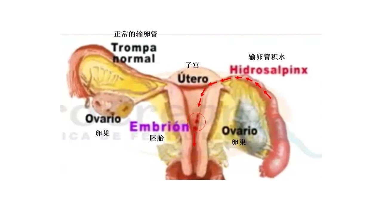 输卵管积水在试管前都需要先处理吗