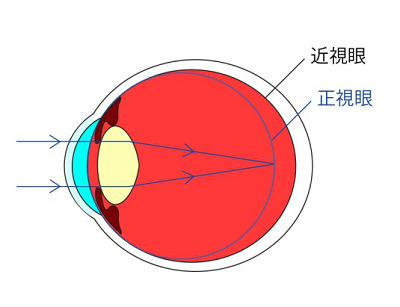 近视眼眼轴怎么,近视眼眼轴怎么变回原来的眼轴