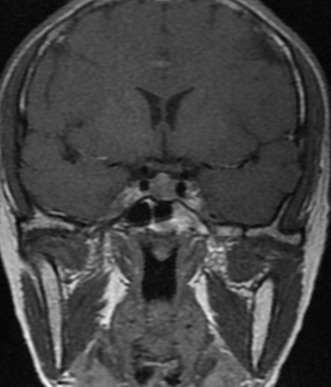 经鼻微创手术治疗泌乳素型垂体瘤