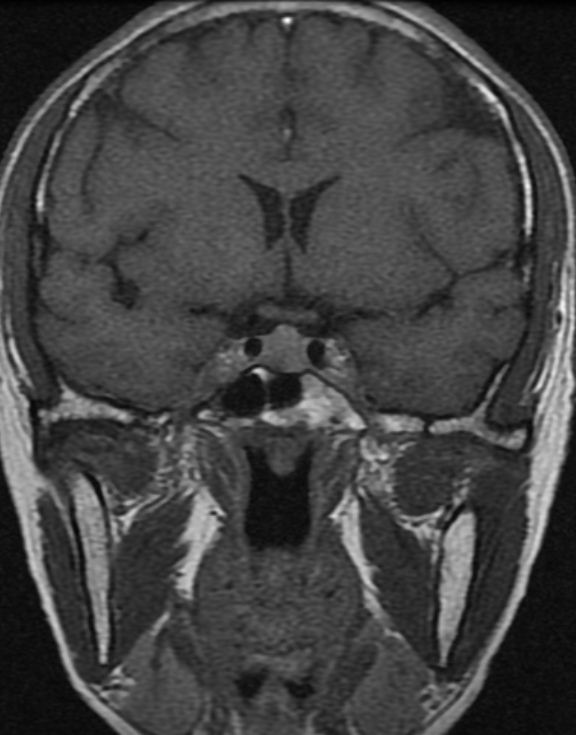 经鼻微创手术治疗泌乳素型垂体瘤