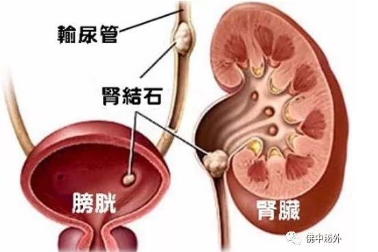 结石从膀胱到尿道图片图片