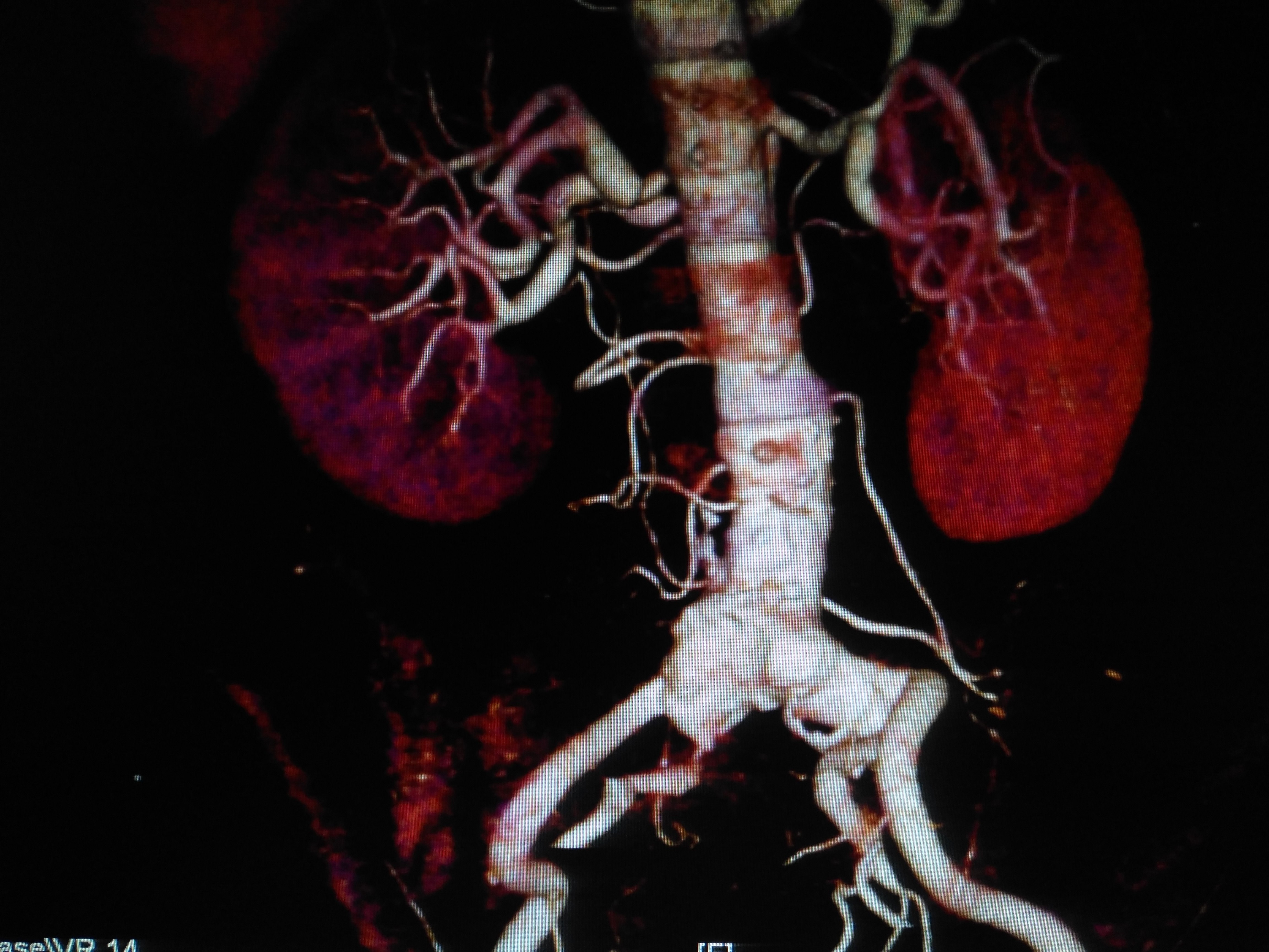 感染性破裂腹主动脉瘤手术治疗