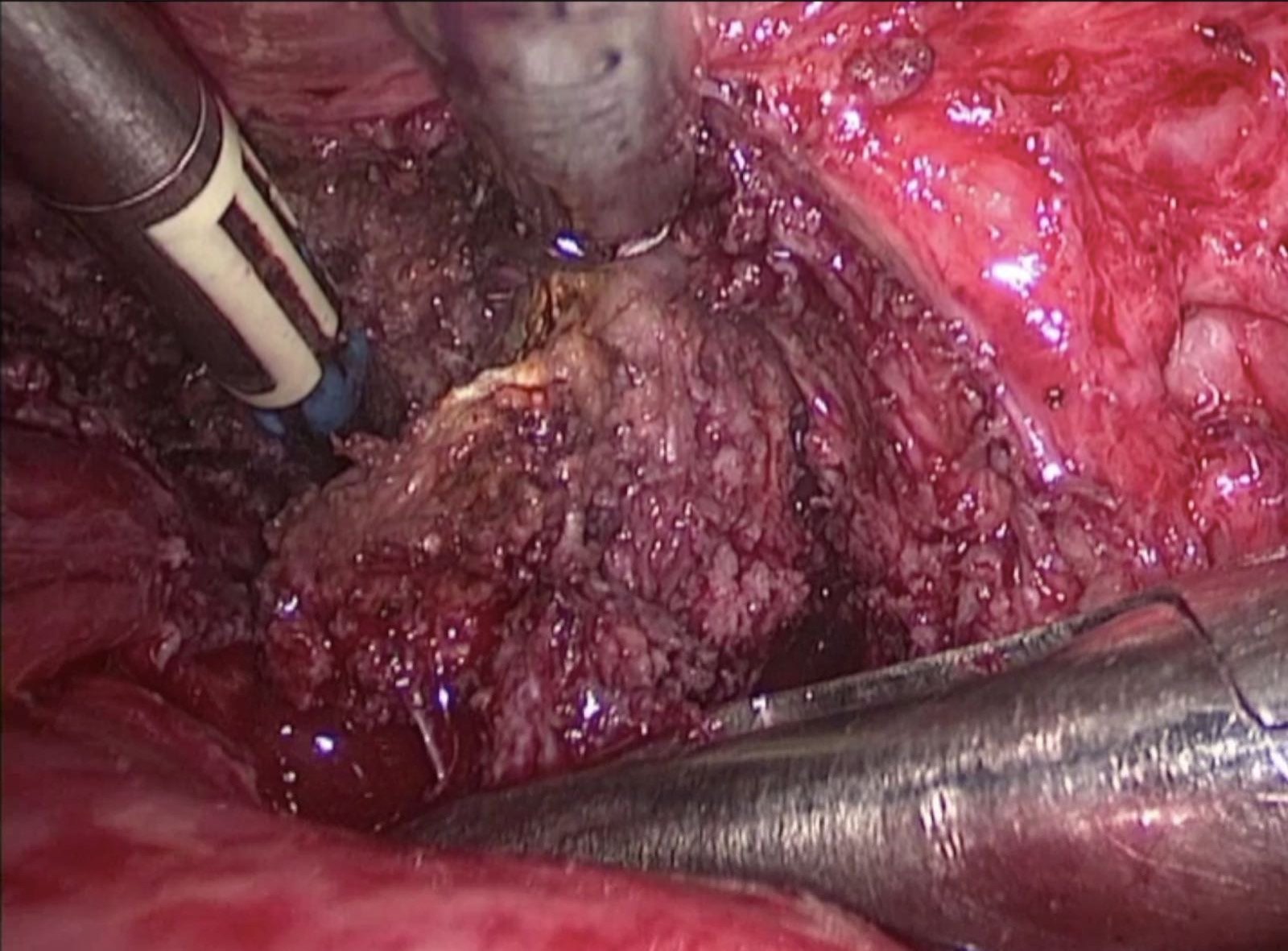 直肠深部子宫内膜异位症特殊案例汇报 - 好大夫在线