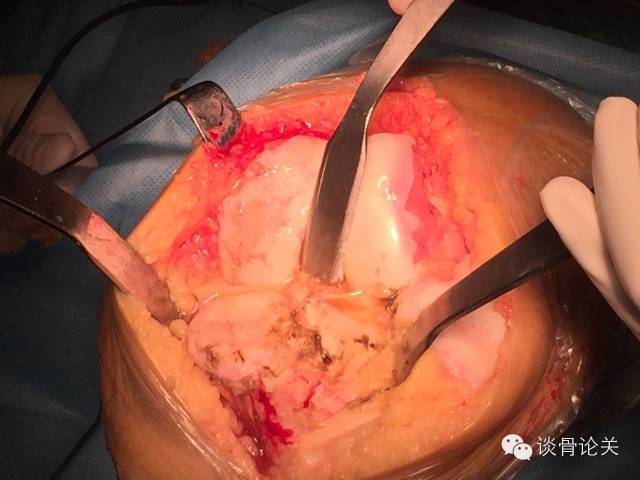 【全膝置换新技术】无需髁间截骨的膝关节置换术 - 好大夫在线