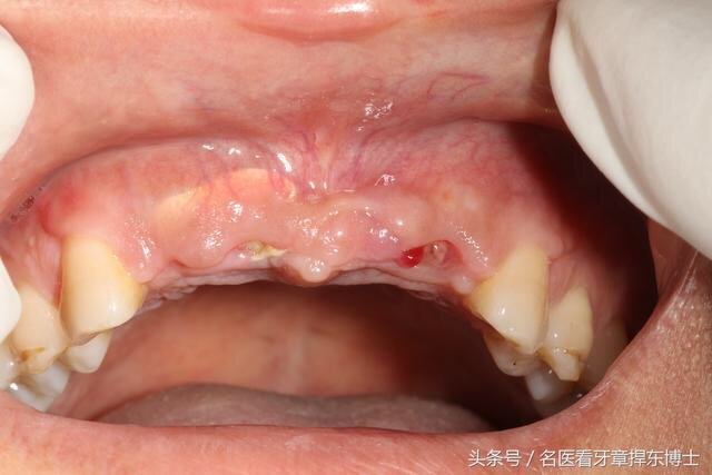 上前牙外伤缺失后的完美再现