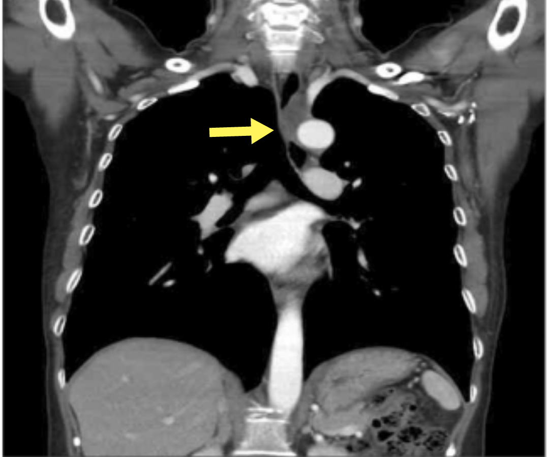 纵隔囊肿非官方诊疗指南