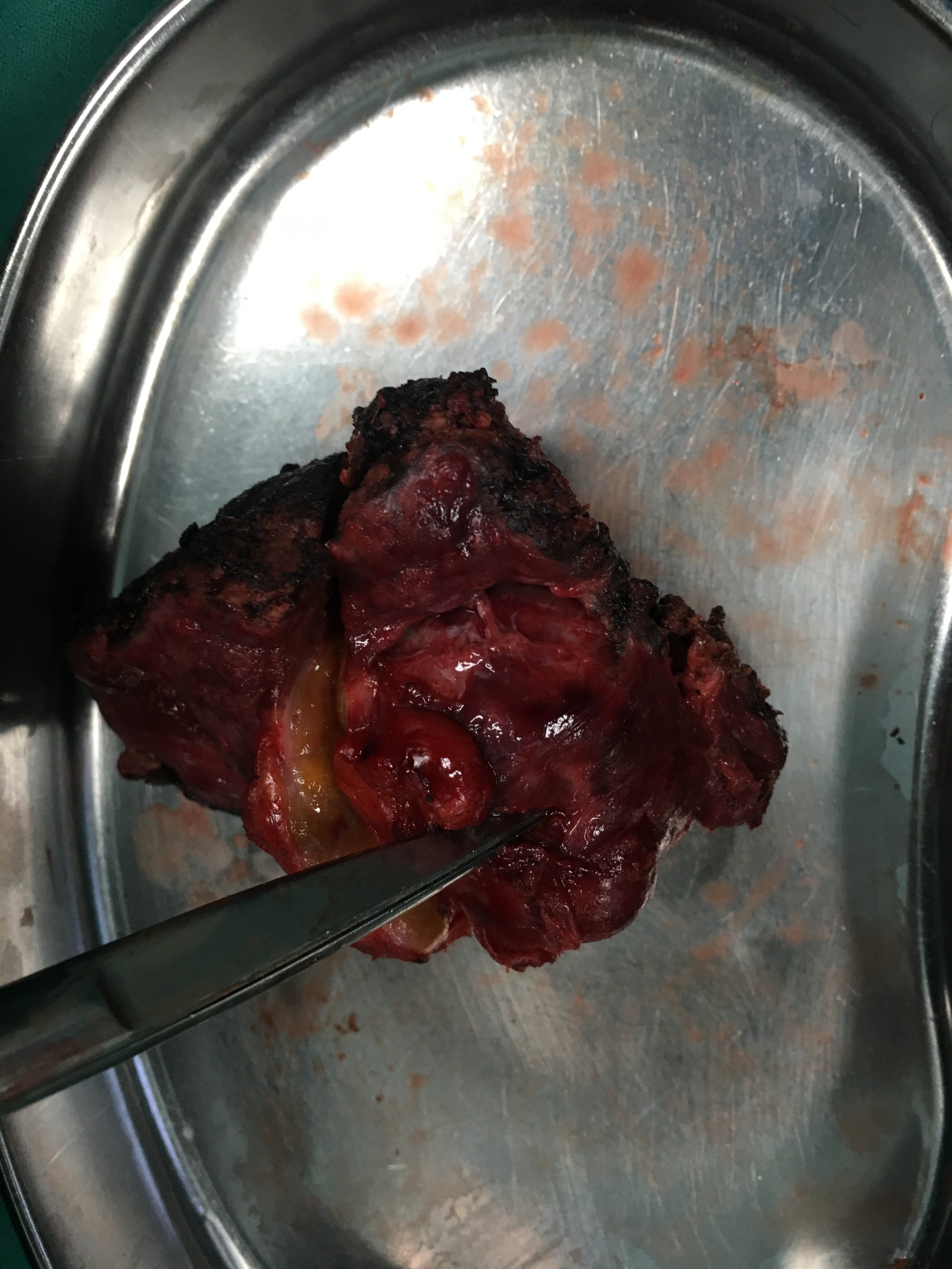 全腹腔镜下肝肿瘤切除手术 - 好大夫在线