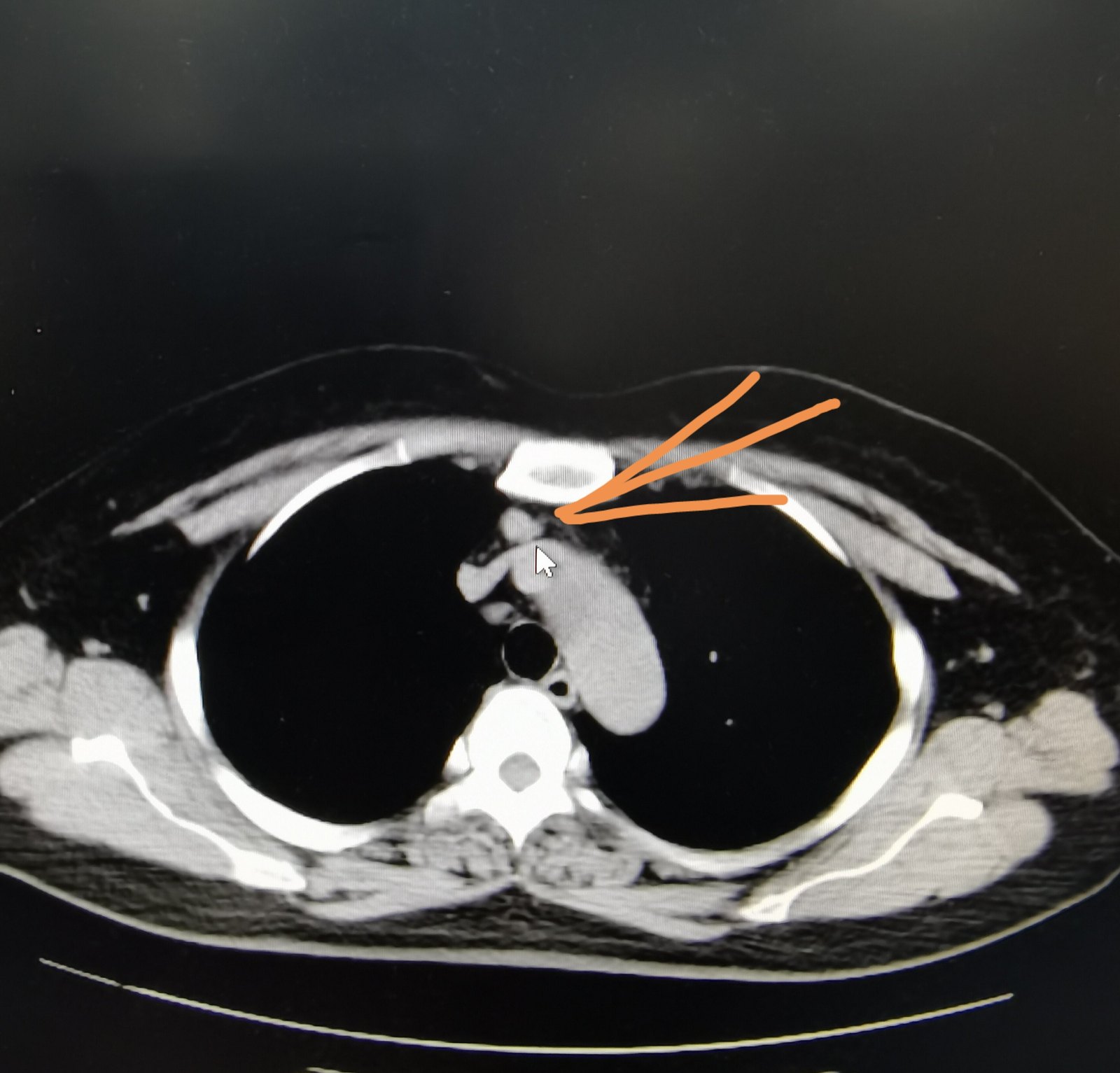 刘懿博士说肺癌三七一六肺磨玻璃结节消散了前纵隔结节没变