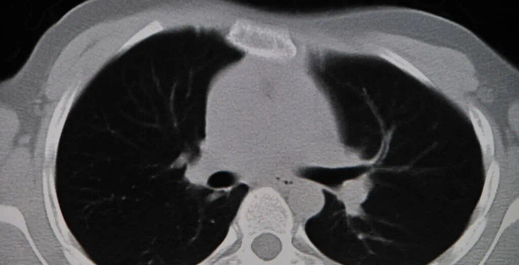 肺部小结节 肺部小结节