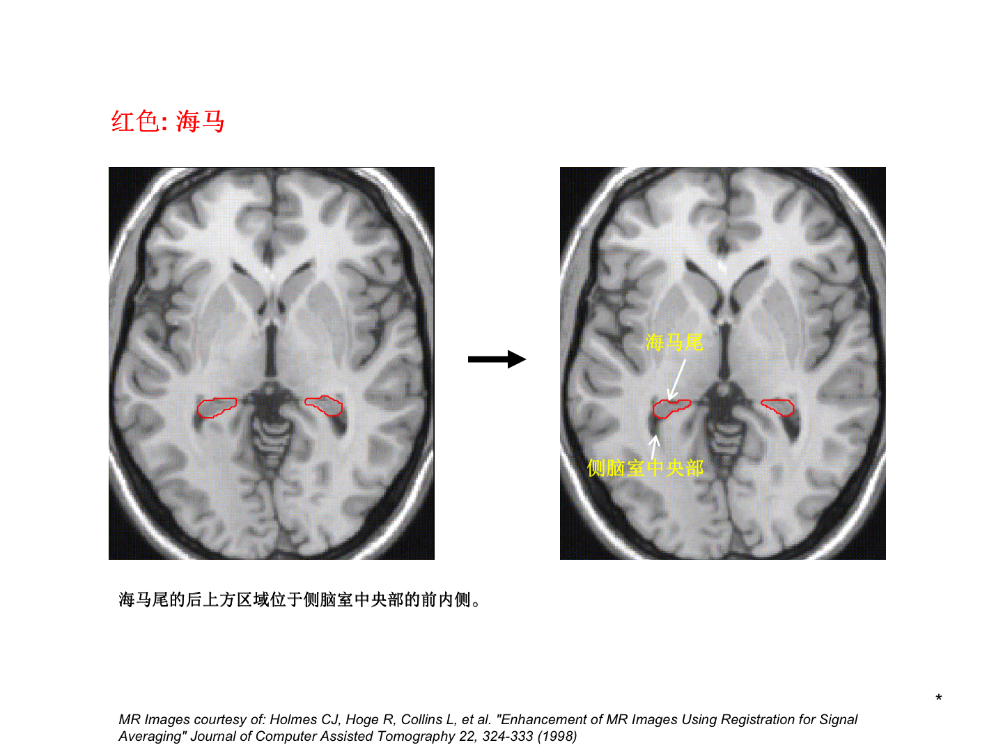 腦放療時如何精確勾畫海馬 - 好大夫在線