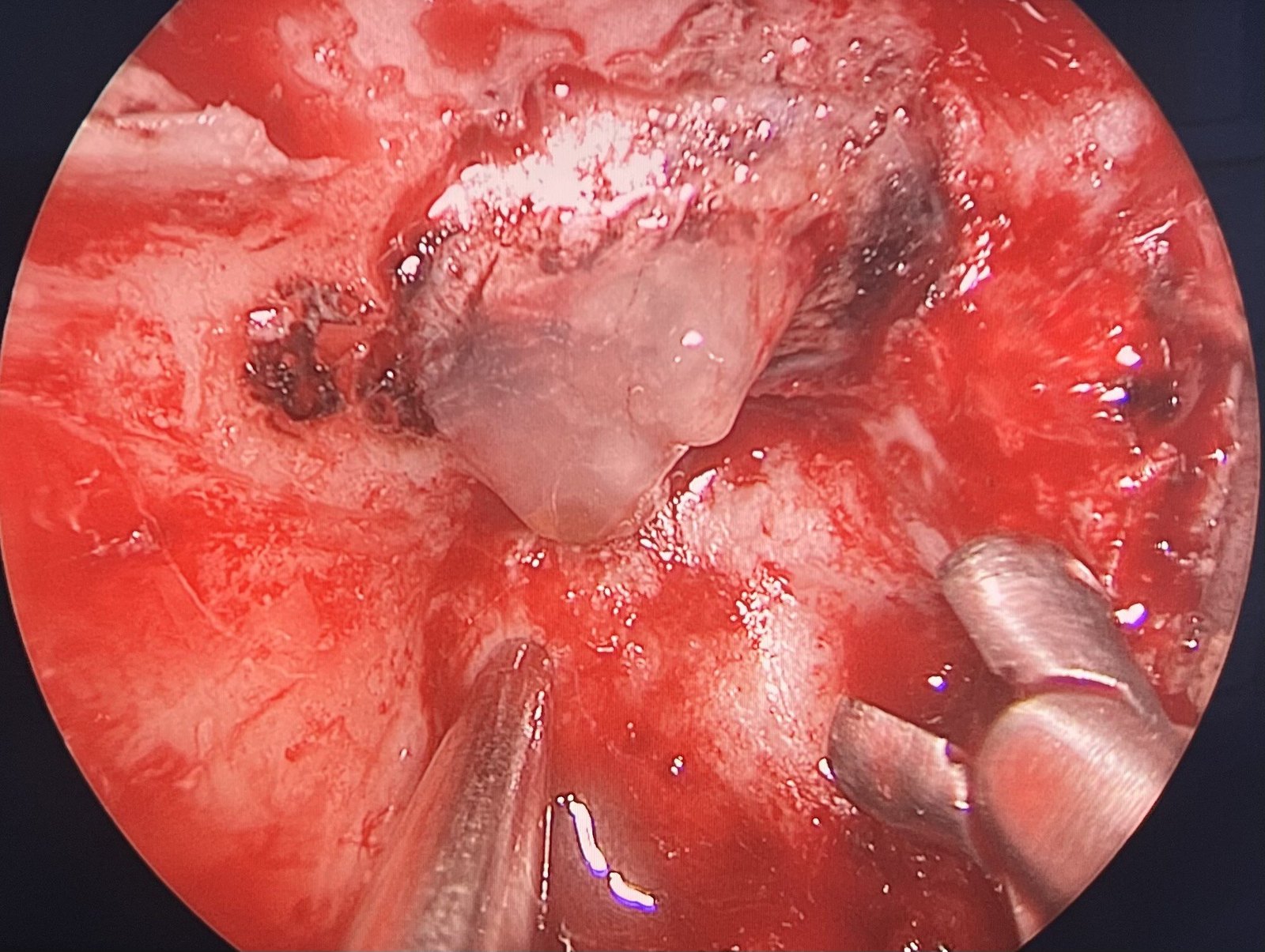 rathke囊肿,经鼻微创手术轻松切除_垂体瘤_症状表现_治疗方式 - 好