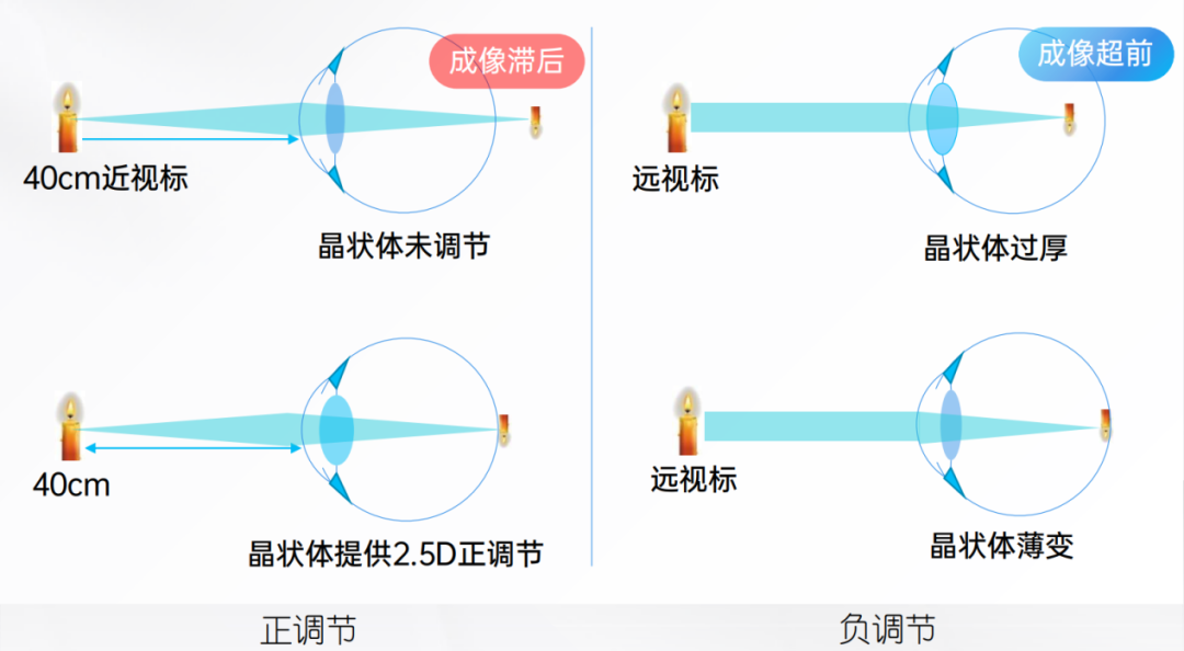 正向調節和負向調節睫狀肌晶狀體變薄和變厚真性近視治療的努力方向