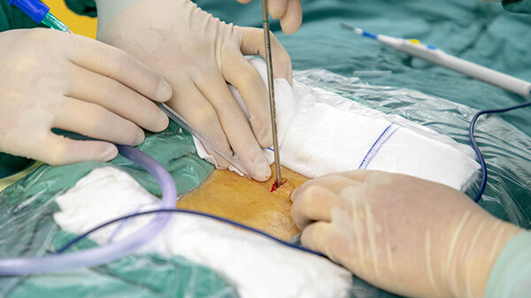 图10:脊柱微创手术,椎间孔镜手术部分年轻人或椎间盘突出不严重的患者