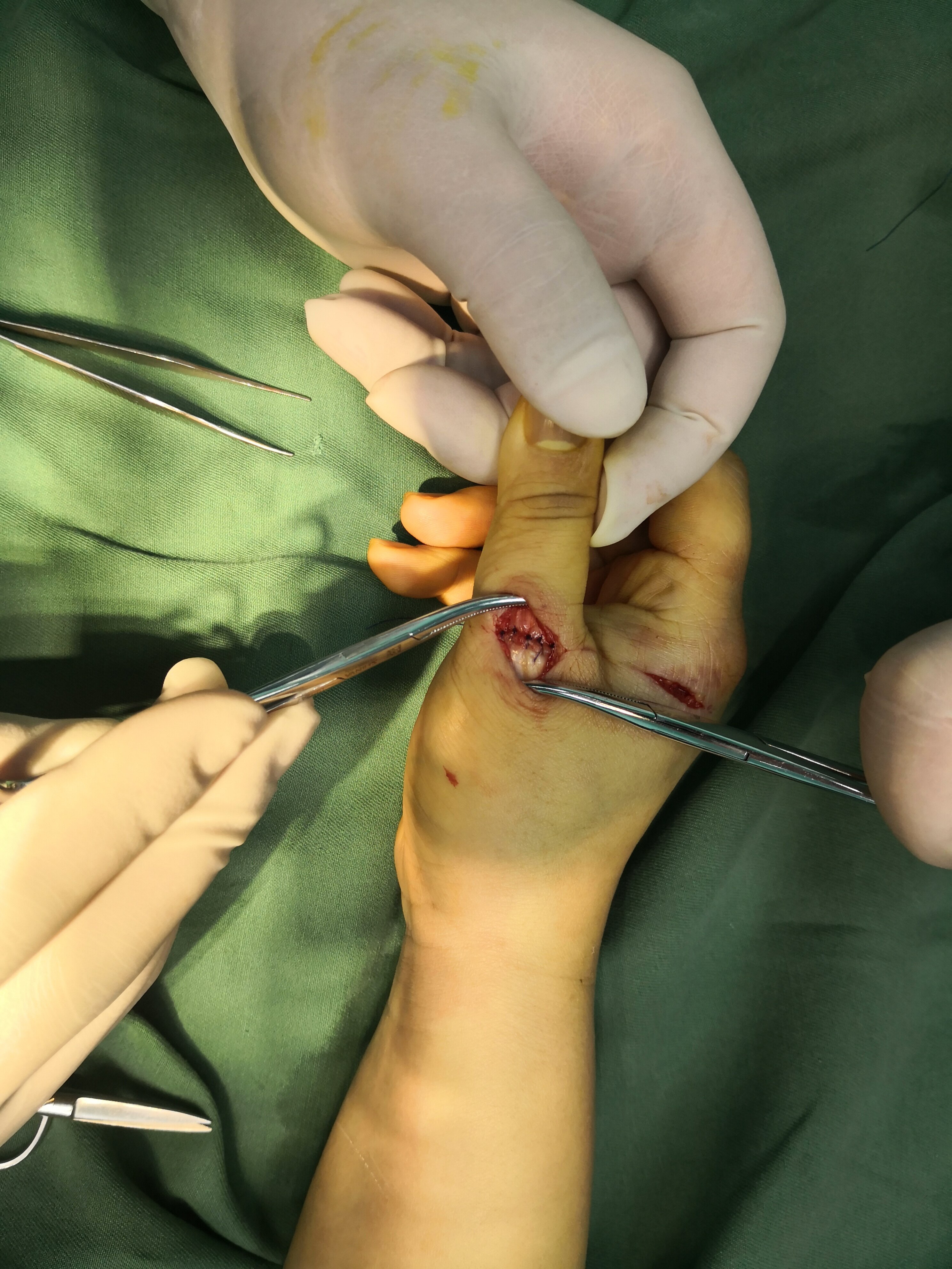 手术清创缝合肌腱吻合术治疗刀砍伤手指拇指伸指肌腱断裂 