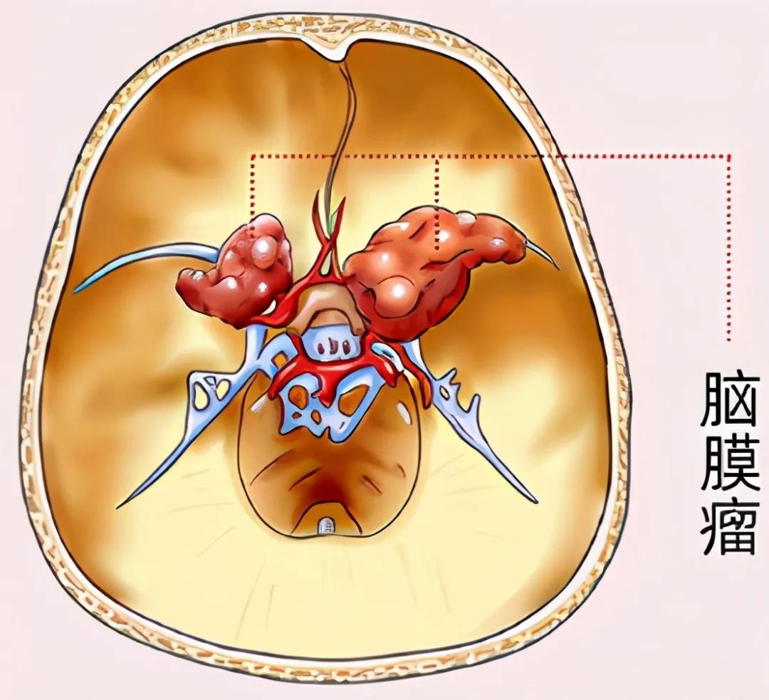 脑膜瘤善于伪装的坏蛋