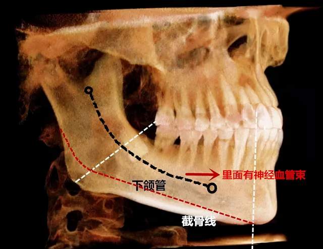 下颌角手术截下来的骨头多就是成功吗?