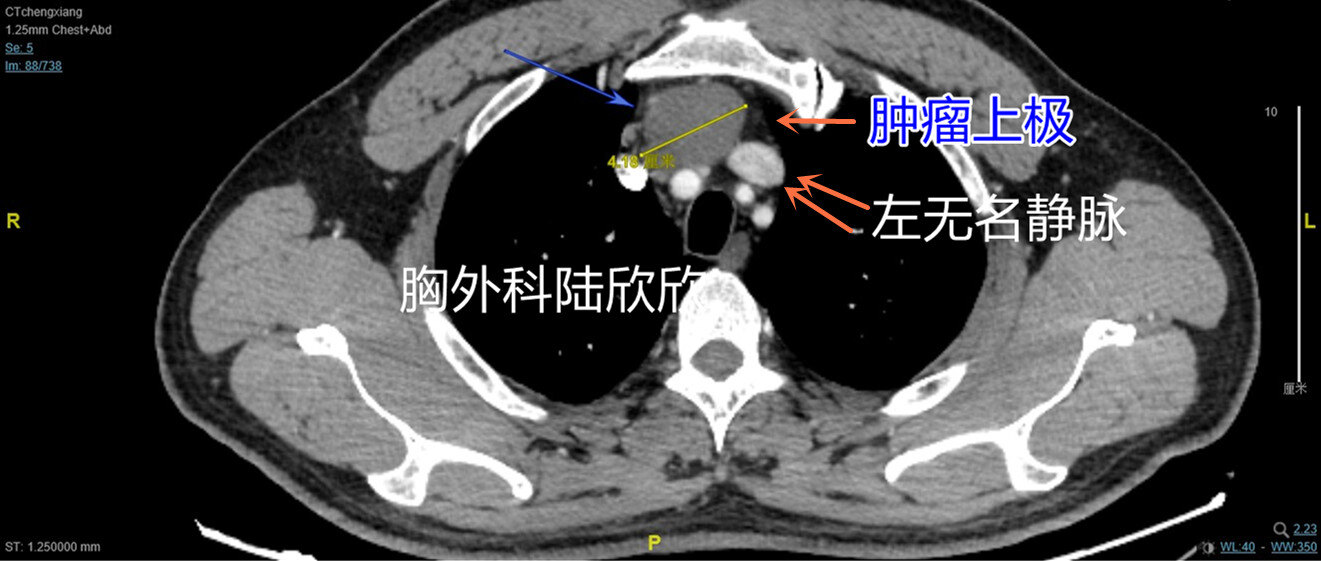剑突下胸腔镜手术切除前纵隔9厘米胸腺肿瘤 - 好大夫在线