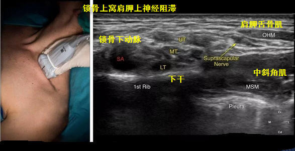 锁骨上窝肩胛上神经阻滞.jpg