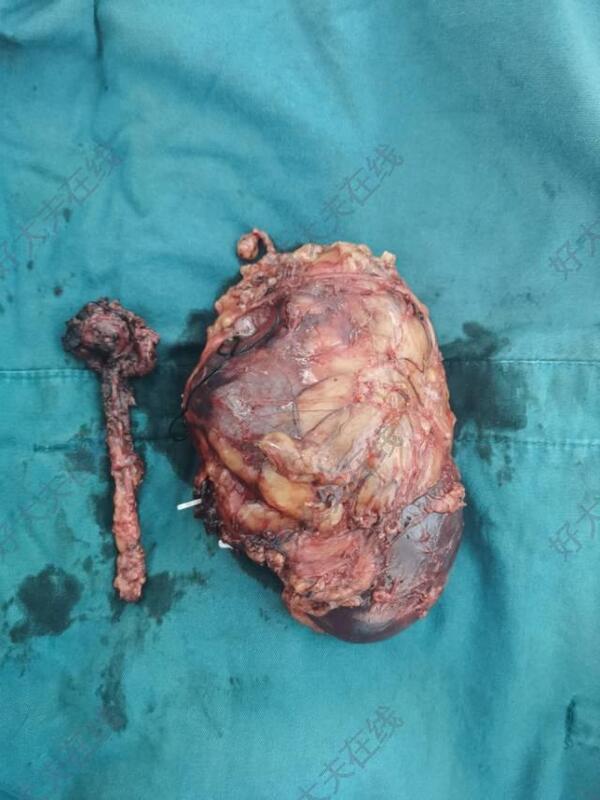 肾肿瘤图片早期图片