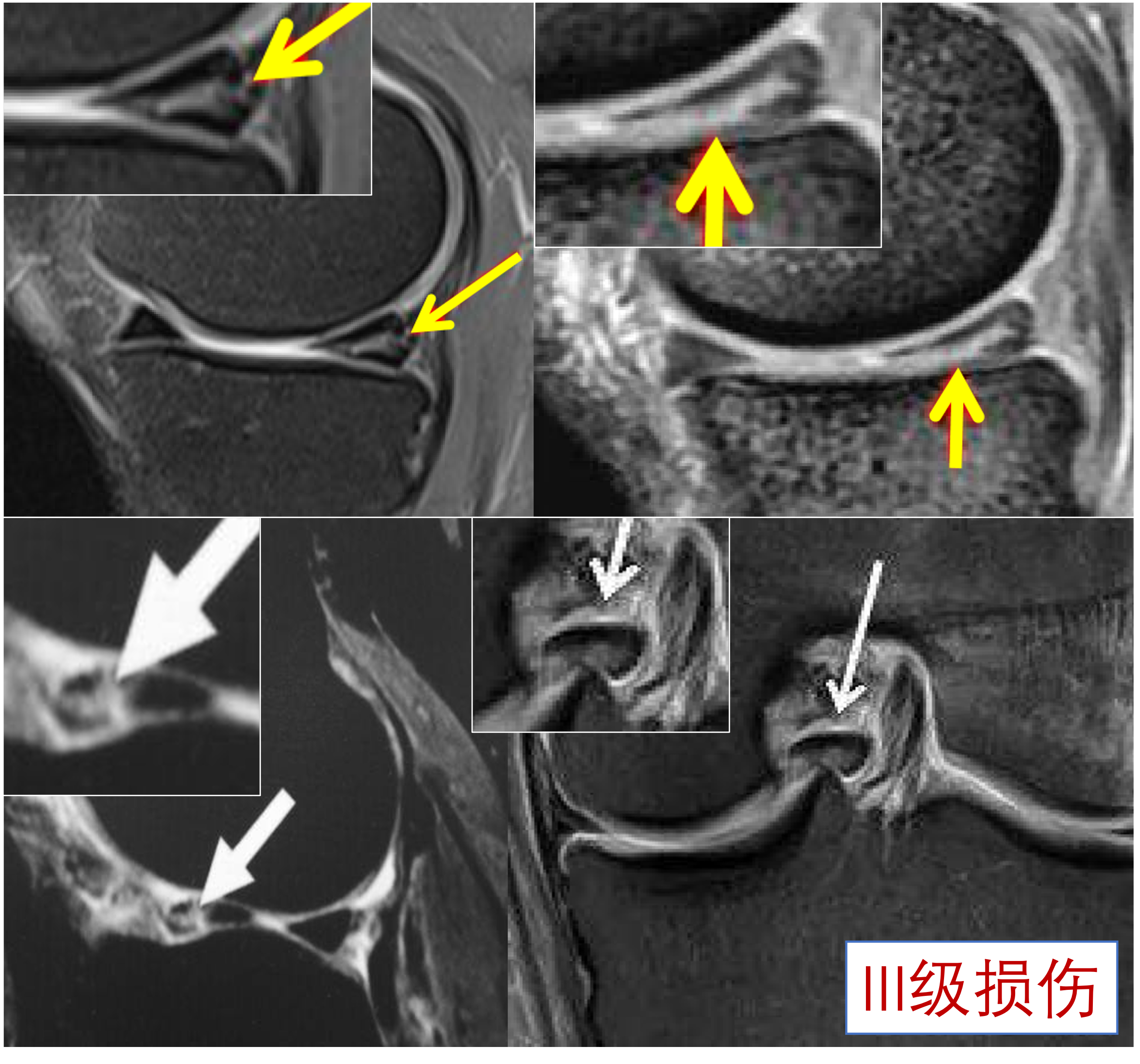 半月板损伤3级.png
