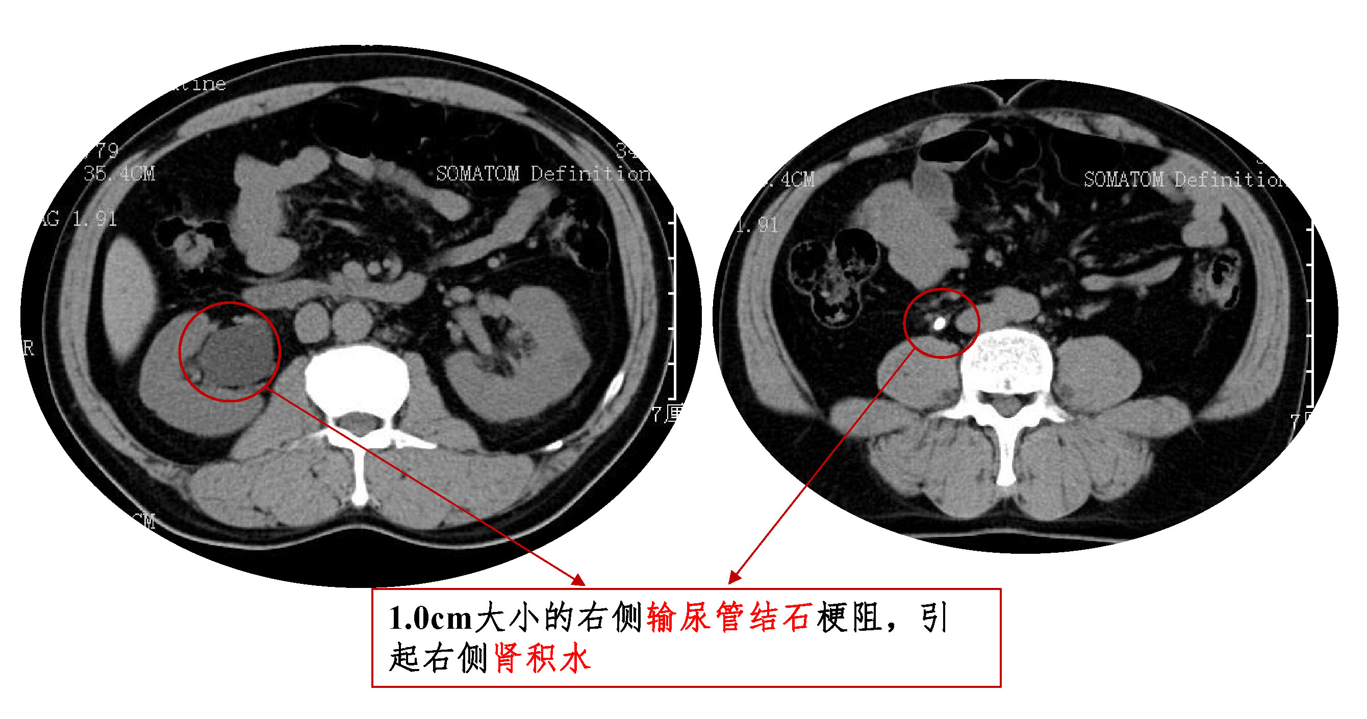输尿管结石引起肾积水.jpg