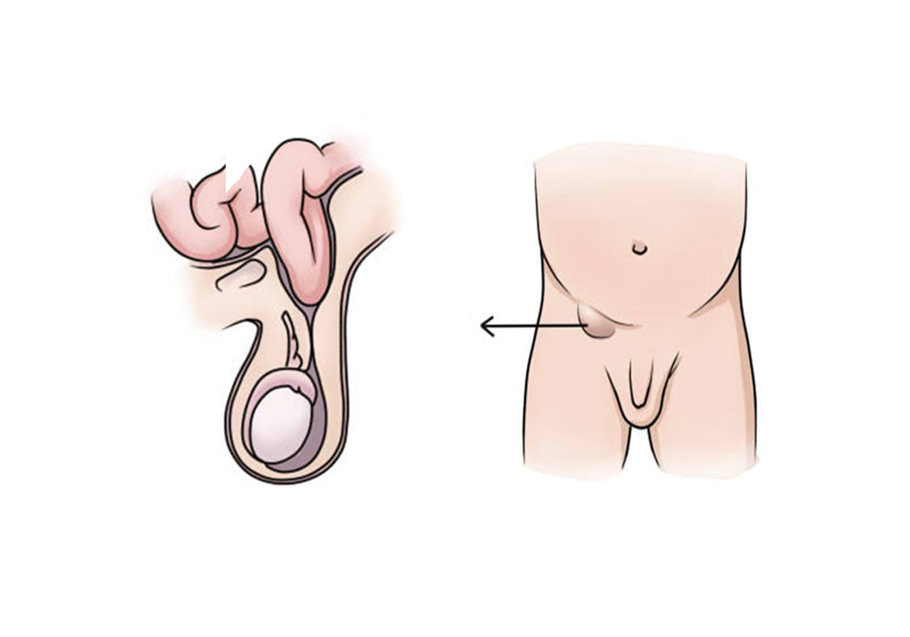 男性疝气位置图片