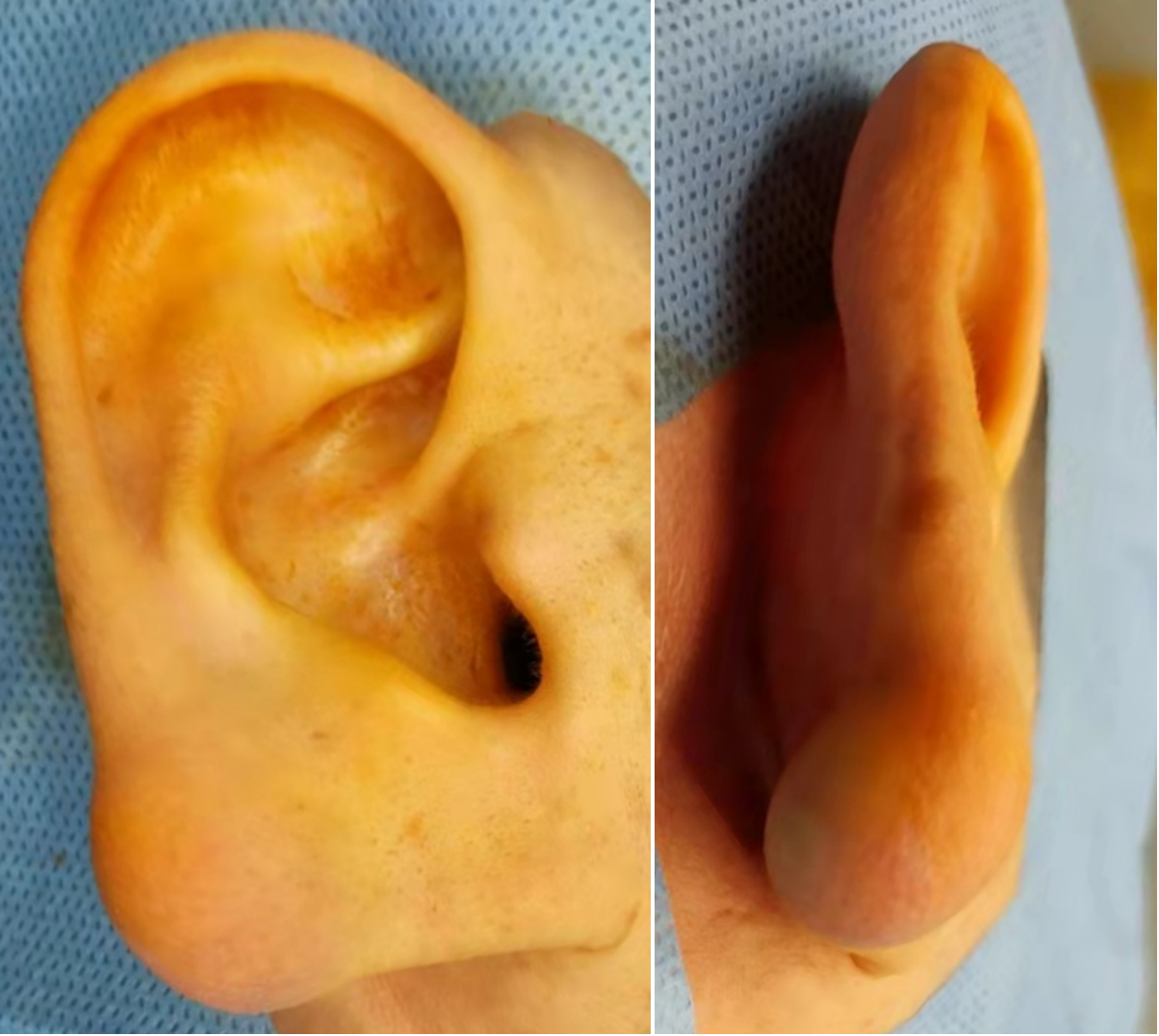 耳朵囊肿是什么引起的图片