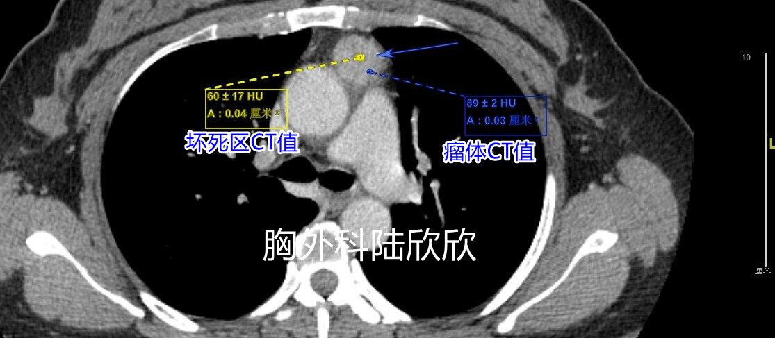 肿瘤中下极内部坏死区CT值水印.jpg