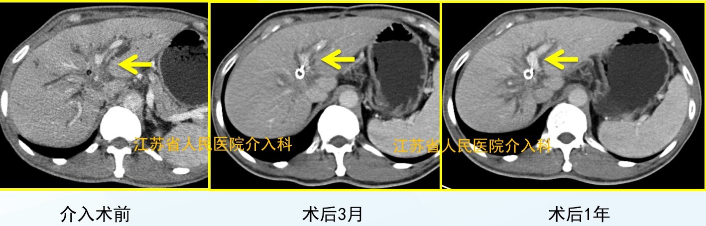 CSTENT-2.jpg