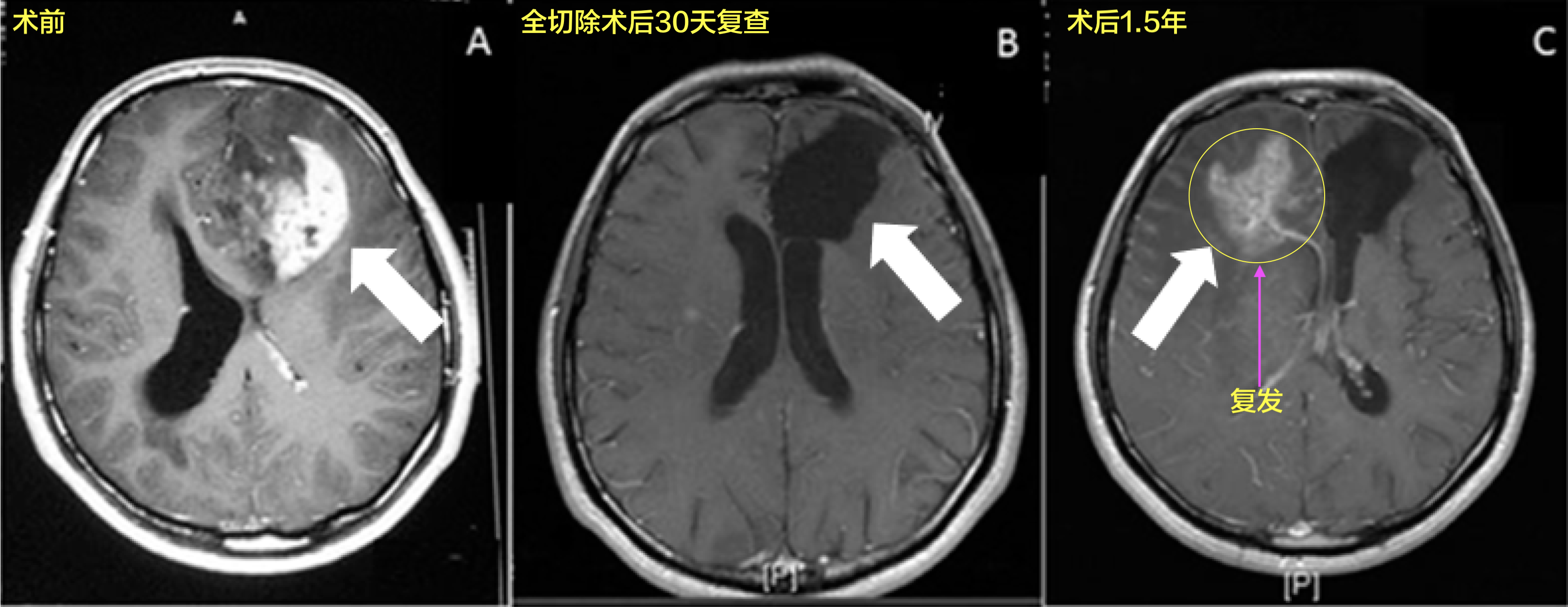 老年胶质母细胞瘤3.png