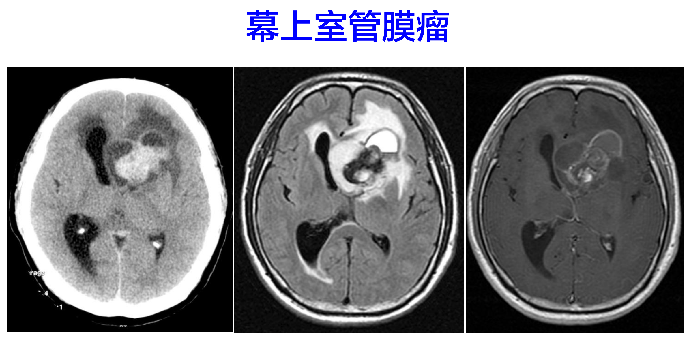 順鉑,卡鉑,環磷酰胺,依託泊苷似乎是治療室管膜瘤最有效的藥物,更強