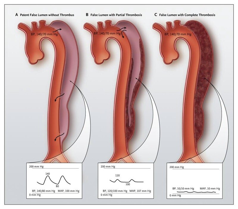 b型主动脉夹层假腔血栓形成与预后的关系 