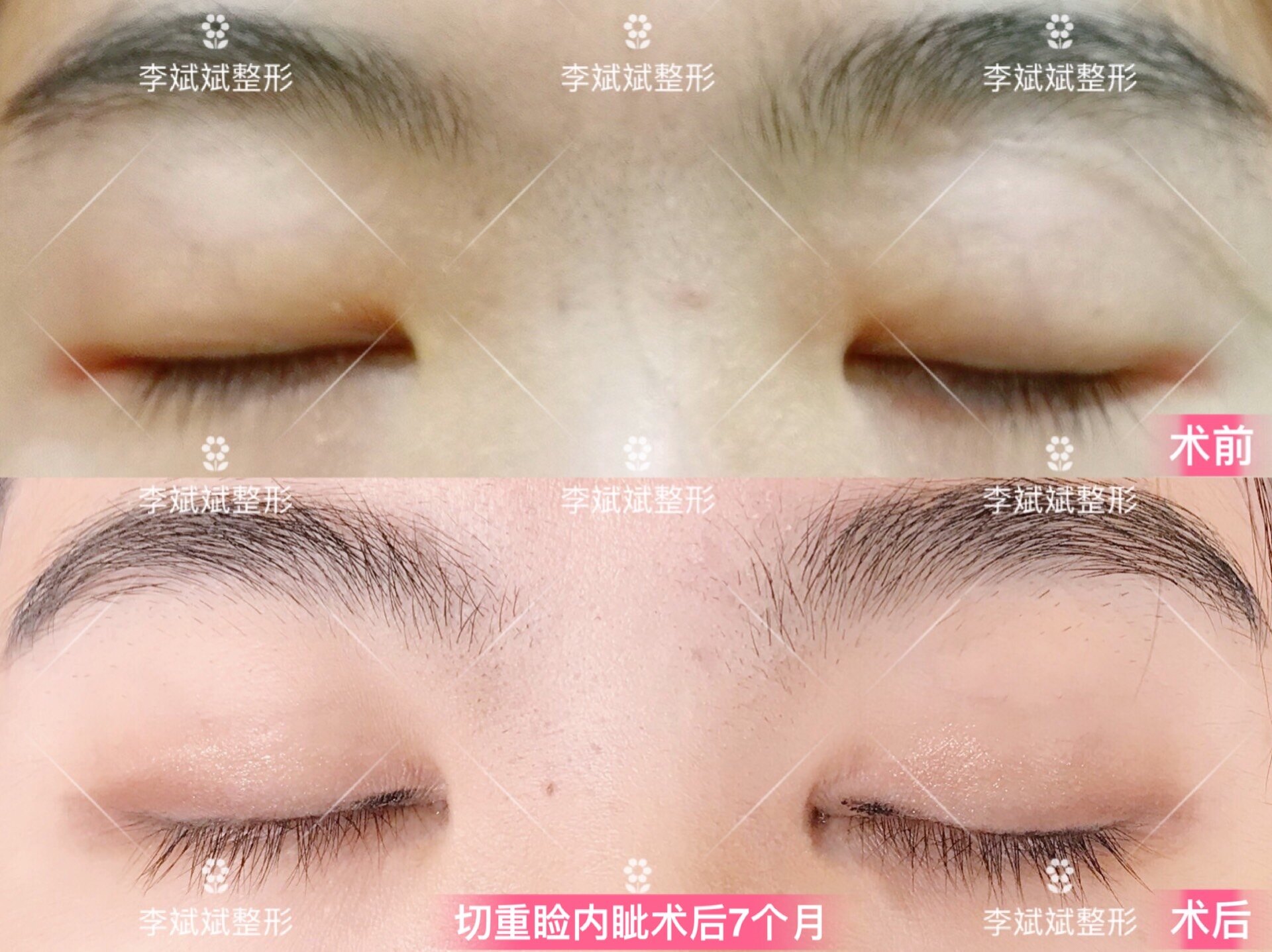 【双眼皮】双眼皮 开内眼角案例合集_双眼皮手术_双眼皮手术治疗介绍