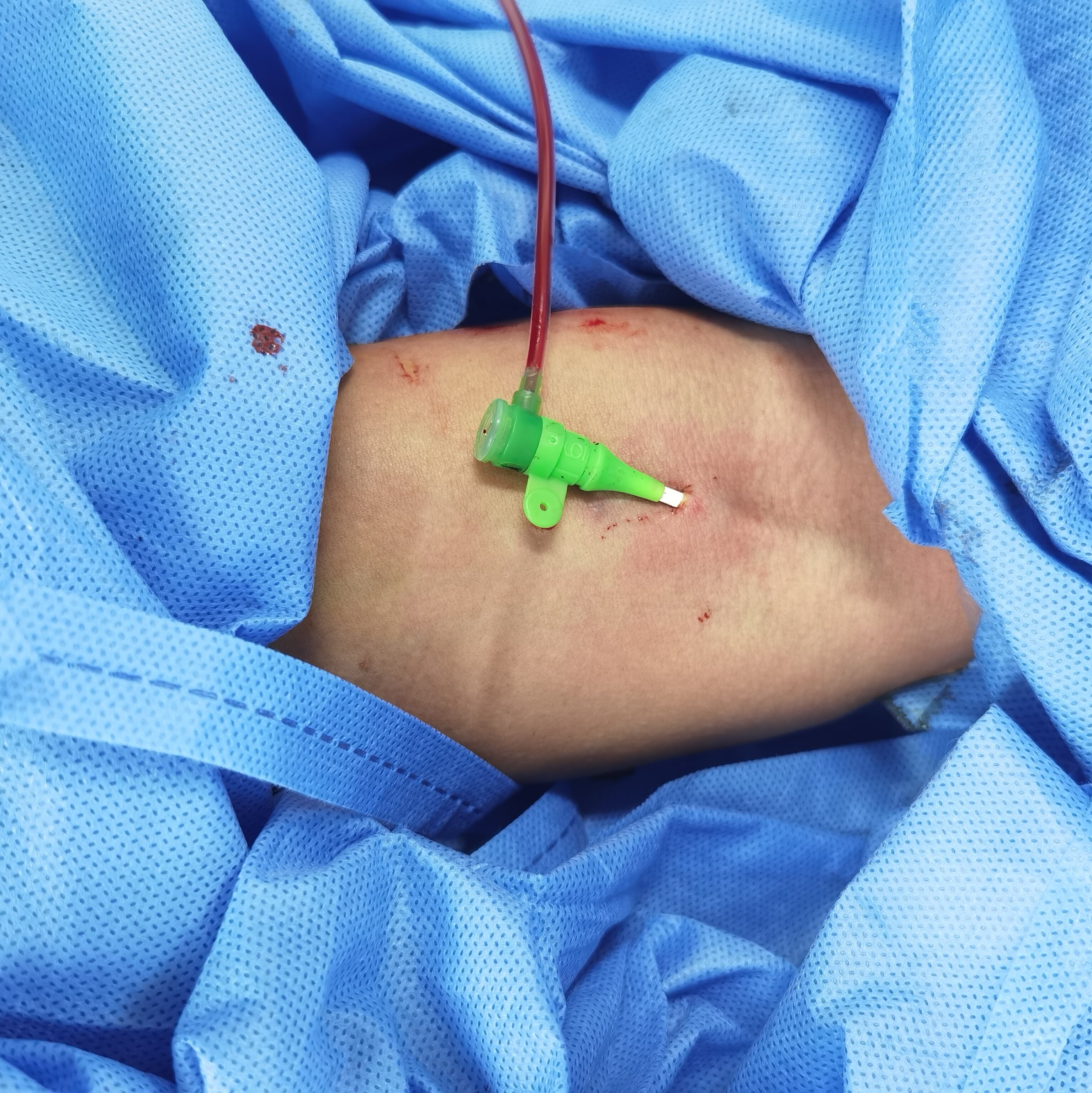 经肘部静脉穿刺,做右心导管不用卧床了