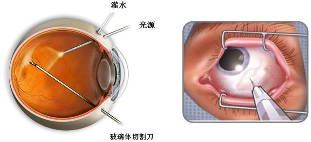 玻璃体切割手术源于上个世纪70年代,使用特制的套管针直接穿刺白眼球