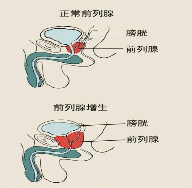 前内腺位置图片