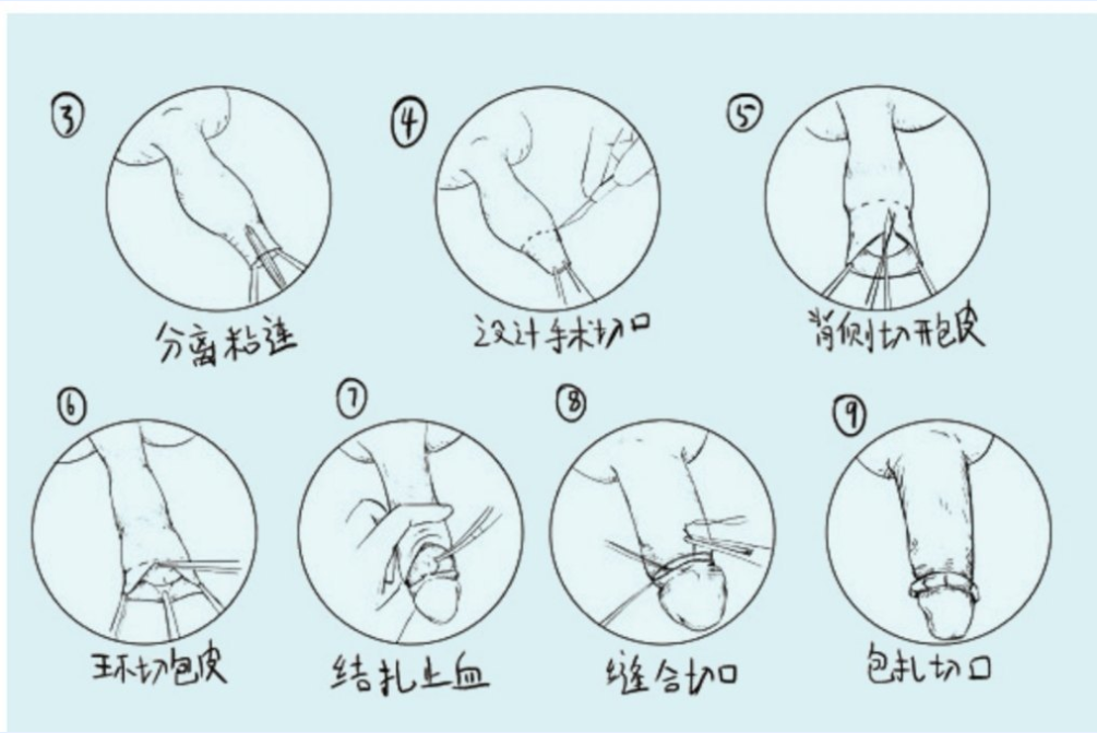 (包皮解惑备忘录)