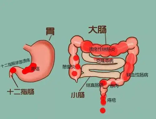 消化道出血卡通图片