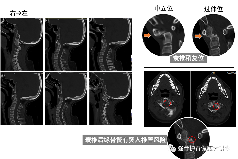 寰枢关节ct图片