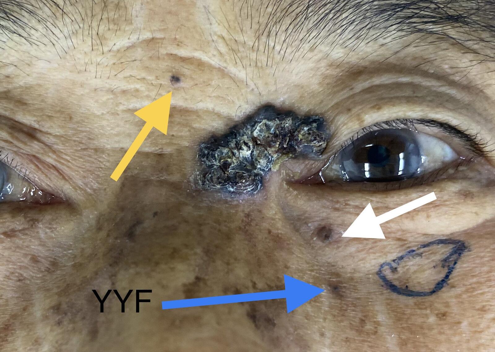 眼睑肿块系列之九&内眼角巨大肿瘤的切除与重建和早期基底细胞癌表现