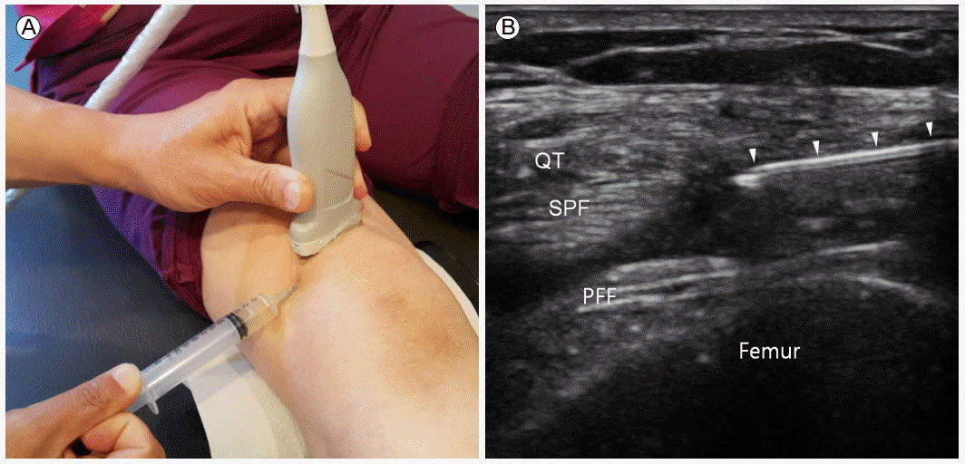 膝前痛,竟是小小脂肪垫在作祟_膝关节损伤_症状表现_治疗方式 - 好