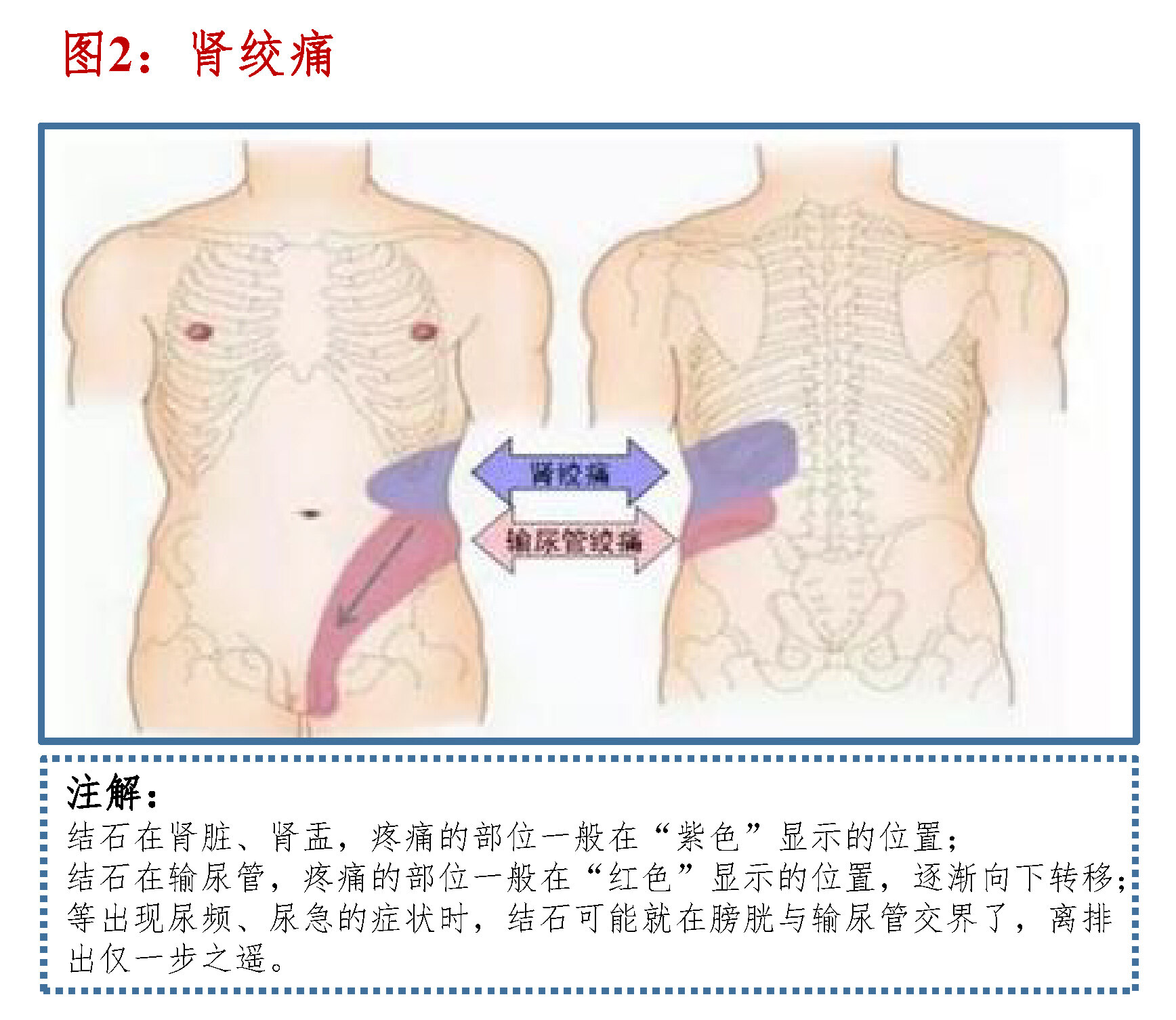 图2：肾绞痛.jpg