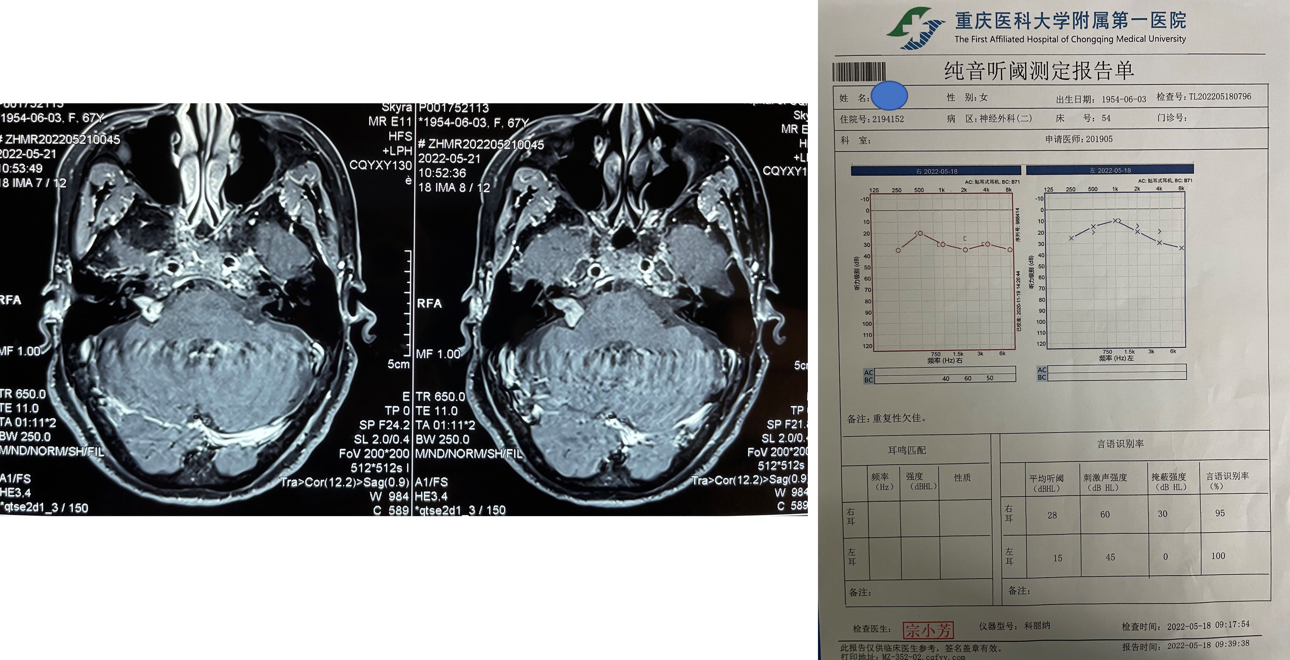 关于听神经瘤的残余听力保留问题_听神经瘤_介绍_治疗方式 - 好大夫